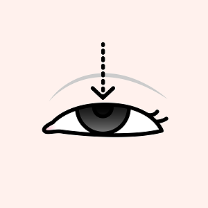 形成外科：眼瞼下垂